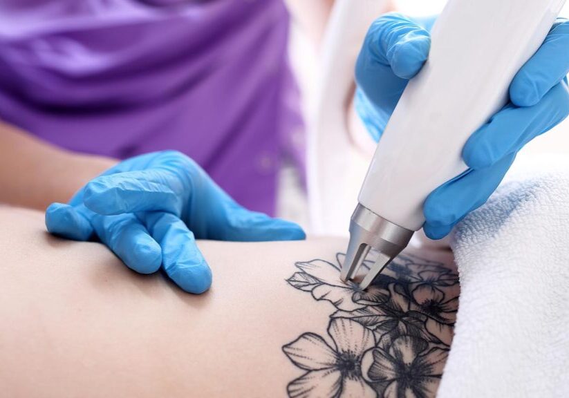 AALP-Laser-Tattoo-Removal-16x9